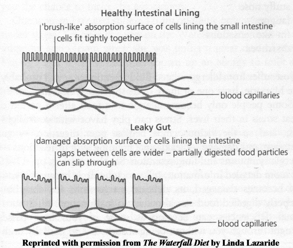 leaky-gut-picture_web