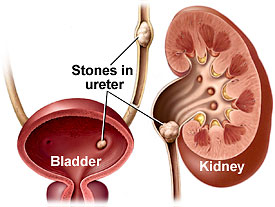 Natural Remedy for Kidney Stones