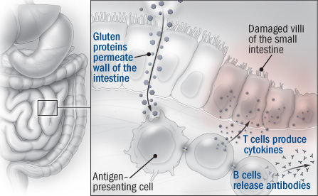 autoimmune response to gluten All About Gluten