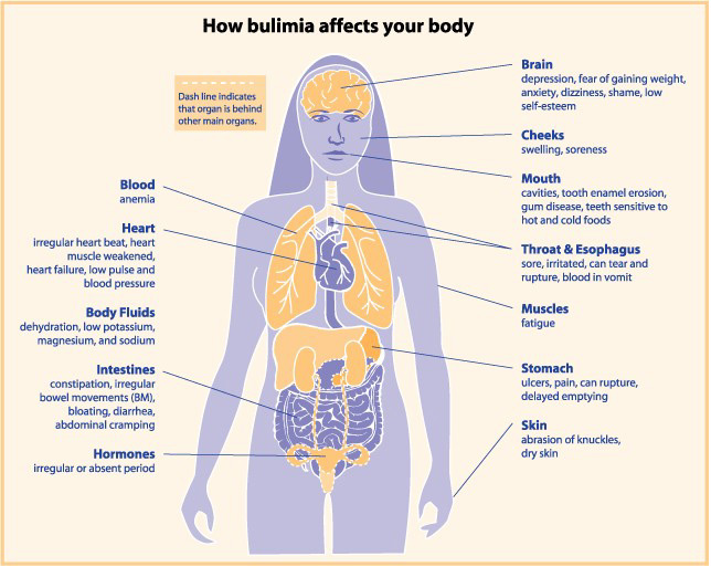 bulimia-effects