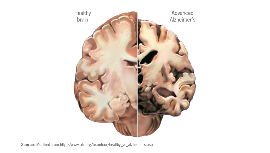 Brain atrophy in advanced Alzheimer's disease.